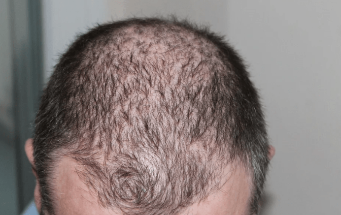 hair loss remedies