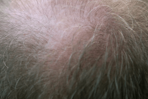 hair loss